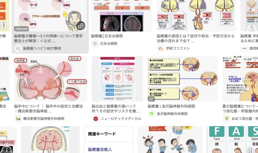脳梗塞
